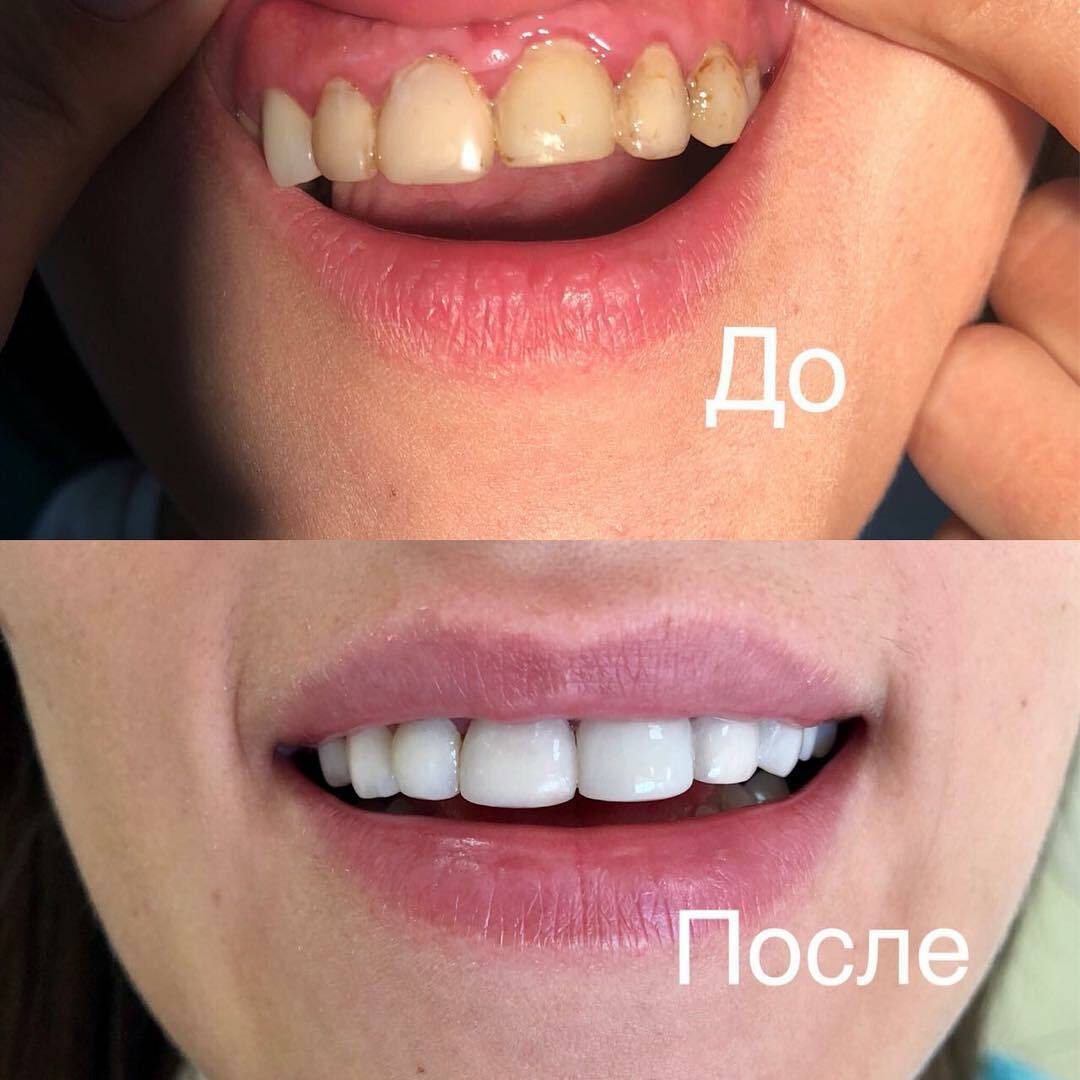 Здоровые зубы и дёсны: красивая улыбка для каждого - 2x2.su картинка 6