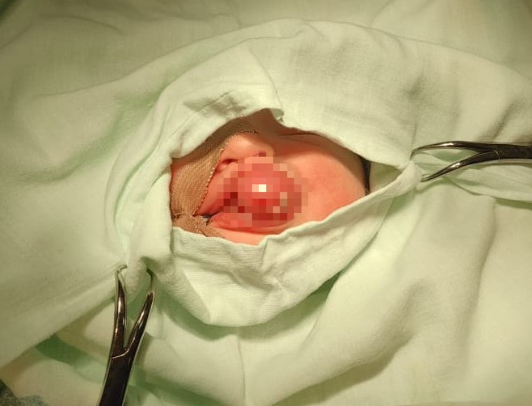 Благовещенские хирурги провели уникальную операцию новорождённому ребёнку с редкой патологией - 2x2.su