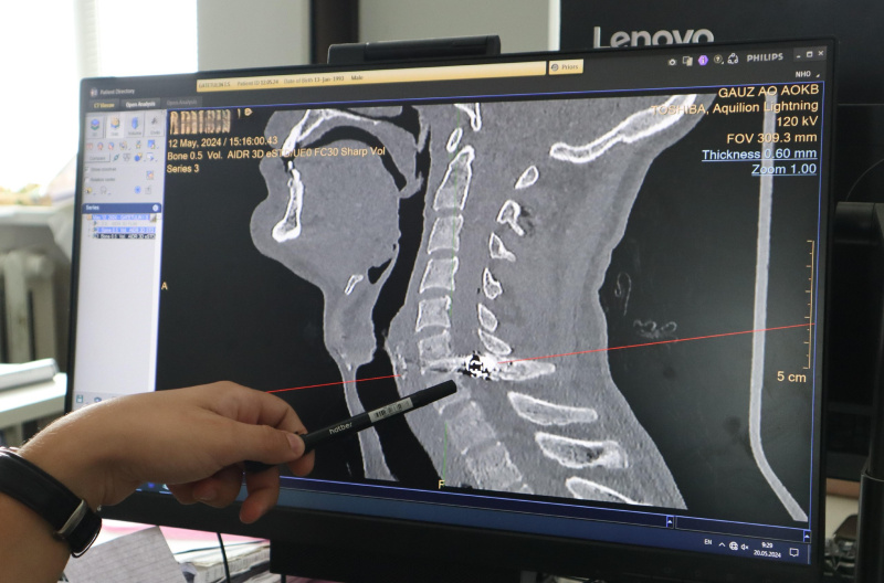 Амурские врачи спасли мужчину, которому пуля попала в спинной мозг