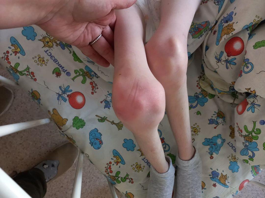 Сотрудников петербургского интерната обвинили в халатности из-за 15-летней умственно отсталой сироты, весящей 13 кг  - 2x2.su картинка 2